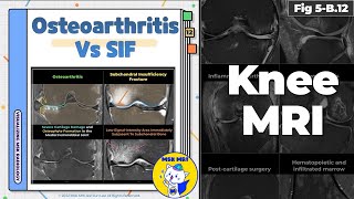 Fig 5B12 Osteoarthritis vs Subchondral Insufficiency Fracture [upl. by Melosa210]