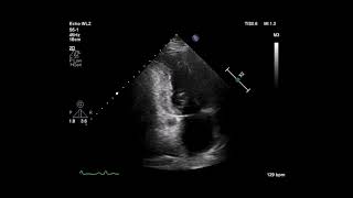 Cardiac Ultrasonogram Showing Apical 2 Chamber View [upl. by Kenelm]