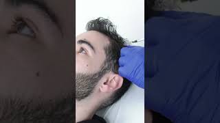 PRP Platelet Rich Plasma for hair loss [upl. by Sunev]