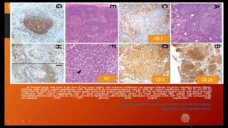 WHO updates Lymphoid neoplasms [upl. by Nroht]