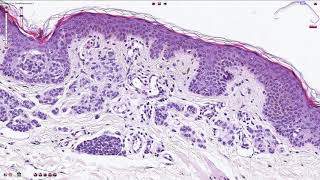 Compound Melanocytic Nevus  Histopathology [upl. by Mozelle]