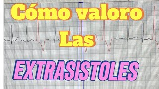 Extrasistoles Video en vivo [upl. by Yemirej]