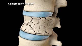 vertebroplasty and kyphoplasty [upl. by Kiraa542]