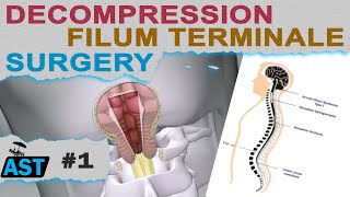 Filum Disease and ACM diagnosis surgeries symptoms info  AST 1 13022024 English [upl. by Nrev]