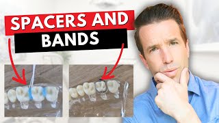 Most Painful Part of Braces  Spacers Bands [upl. by Dosi]