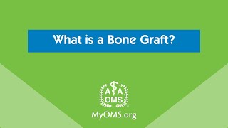 What is a Bone Graft [upl. by Breed]