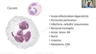 Neutrophilia  GAME 44  Pathology practical slides  MBBS  SRM  Dr GSS  University questions [upl. by Hayton]