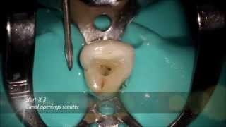 Maxillary Lateral Incisor [upl. by Nosredneh]