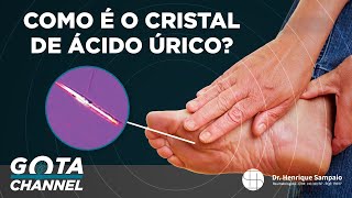 COMO É O CRISTAL DE ÁCIDO ÚRICO [upl. by Remmus626]