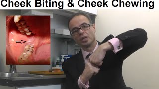 Problems Associated With Cheek Biting Cheek Chewing or Morsicatio Buccarum by Dr Mike Mew [upl. by Kcireddor]