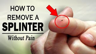 How to Remove a Splinter Without Pain  Home Remedies for Splinters Removal [upl. by Imalda519]