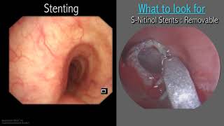 Mastering Bronchoscopy for Thoracic Surgery Chapter 3 [upl. by Kiersten314]