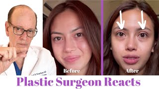 Getting Eyelid Surgery Blepharoplasty  Plastic Surgeon Reacts [upl. by Ahtabat]