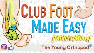 CLUB FOOT Pathoanatomy Made Easy  The Young Orthopod [upl. by Kaltman830]