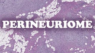 LE PERINEURIOME – PATHOLOGIE [upl. by Helena262]