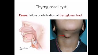 Thyroglossal cyst [upl. by Merrili777]