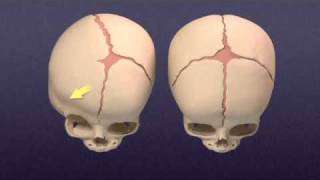 Craniosynostosis  Mayo Clinic [upl. by Atiekram]