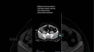 Bilateral renal concretionsLeft distal ureteric calculus with mild proximal hydroureteronephrosis [upl. by Aix268]