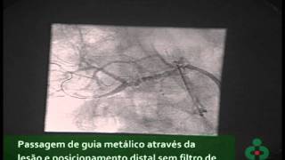 Angioplastia de Artéria Renal [upl. by Behl]