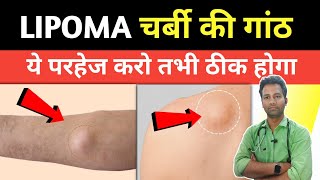 lipoma me parhej  लिपोमा में क्या नहीं खाना चाहिए  Lipoma treatment  Dr tarun [upl. by Falconer]