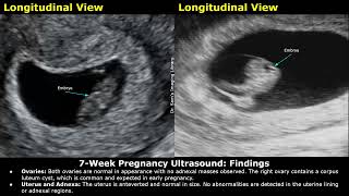 7 Week Pregnancy Obstetric Ultrasound Report Example  Normal Intrauterine Pregnancy USG Reporting [upl. by Eniger]