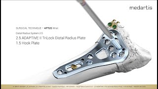 Surgical Technique Animation  25 ADAPTIVE II TriLock Distal Radius Plate with the 15 Hook Plate [upl. by Tahp]