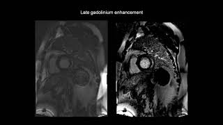 How to assess myocarditis with the help of cardiac MRI CMR [upl. by Ardiek914]