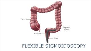 Flexible sigmoidoscopy [upl. by Huxley]