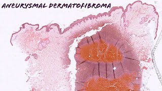 Aneurysmal dermatofibroma dermatofibroma with internal hemorrhage pathology dermpath dermatology [upl. by Davie777]