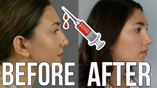 Nose Job Experience  My Rhinoplasty  Plastic Surgery Story [upl. by Chicoine]