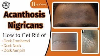 Acanthosis Nigricans How to Get Rid of Dark Neck amp Armpits  Dr Nivedita Dadu [upl. by Eskill]