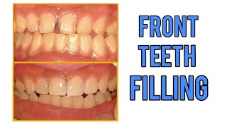 Front Teeth Filling 11122122  TEETH SMILE RESTORATION [upl. by Swinton542]