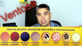 Ventosa Mini Curso de Ventosaterapia  Parte 22 [upl. by Ortiz]