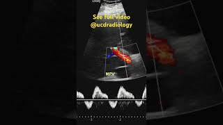 Reversal of portal vein flow radiologyresident medicine doctor radiology radres medschool [upl. by Lai]