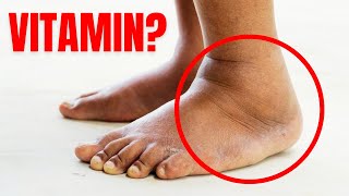 1 Vitamin to Eliminate Swelling in Feet and Legs [upl. by Thilde159]