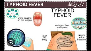 typhoid fever  typhaed bakhar  टाइफाइड बुखार [upl. by Rosmunda]