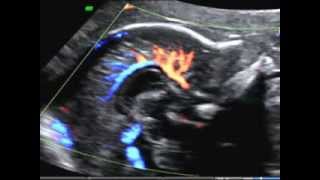 ISUOG How to image the fetal corpus callosum course of the pericallosal artery [upl. by Attalanta]