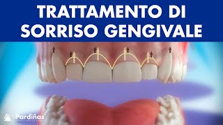 Gengivectomia  Trattamento di sorriso gengivale © [upl. by Gaylord515]