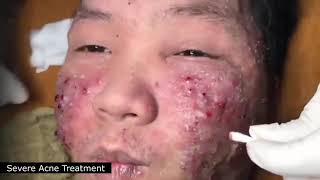 BEST BLACKHEAD AND WHITEHEAD REMOVAL SEVERE ACNE TREATMENT  SATISFYING AND RELAXING VIDEO [upl. by Aitnohs]