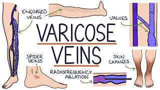 Understanding Varicose Veins [upl. by Anegroeg]