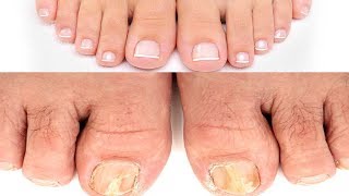 Fungal Nail Infection  3 Simple Home Remedies to get rid of Toenail Fungus  Instant Relief [upl. by Solange]