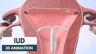 How does an IUD work  3D animation [upl. by Yi]