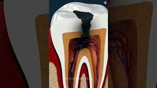 how doctor repair your tooth shorts [upl. by Normand]