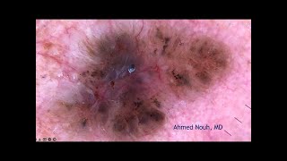 Basal Cell Carcinoma with English subtitles [upl. by Ocsisnarf]