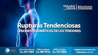 ‪‎YoConElDrSantana‬  Rupturas Tendenciosas  Lesiones Traumáticas de los Tendones [upl. by Jonathon714]