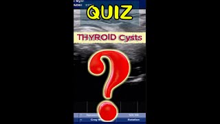 QUIZ  Thyroid Cyst [upl. by Eifos]