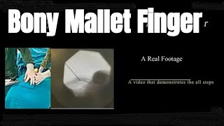 Mallet finger pinning treatment explained  Dr Kemal Gokkus [upl. by Anitsirc198]