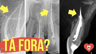 ENDODONTIA COM CONE PASSANDO É ISSO QUE PODE ACONTECER  Endolovers [upl. by Davison]