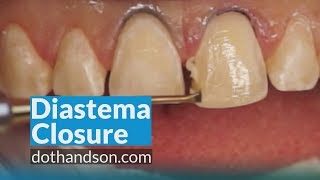 Resin Veneer and Diastema Closure by Dr Dennis Hartlieb [upl. by Kenwee530]