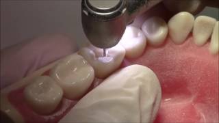 Tutorial on Class I Cavity Preparation Amalgam Restoration  DENTALKART [upl. by Leahcimnhoj]